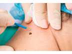 Seeking Genital Warts Removal in London? Visit London Dermatology Clinics