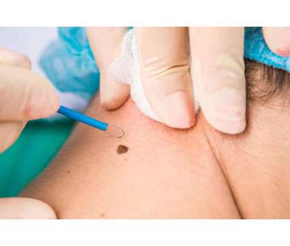 Seeking Genital Warts Removal in London? Visit London Dermatology Clinics is a Medical Care service in Marble Arch LND